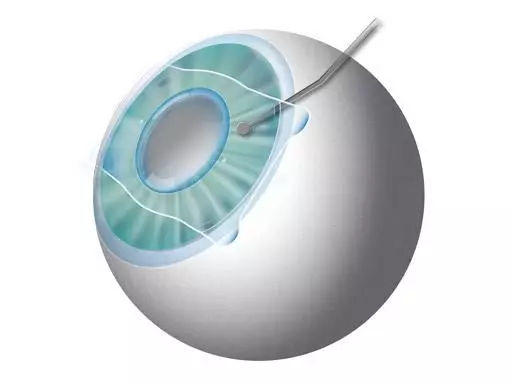 近视眼激光手术后20年后的后遗症,权威讲解近视眼手术的利弊