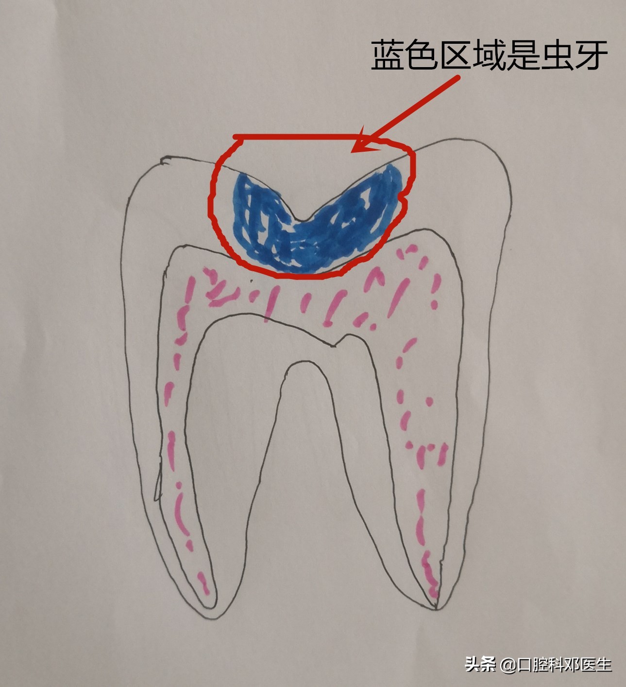 上排虫牙补牙全过程,虫牙补牙疼怎么办