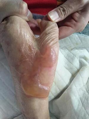 婴儿低温烫伤怎么处理,宝宝低温烫伤怎么处理