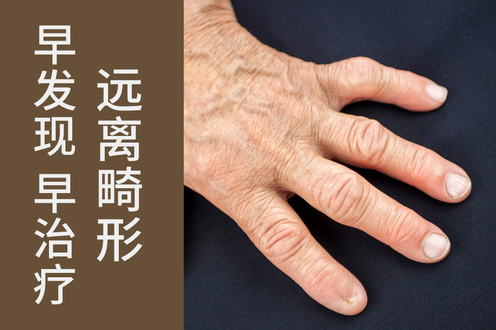 类风湿关节炎早期发现治疗能好吗,早期类风湿关节炎彻底治愈率