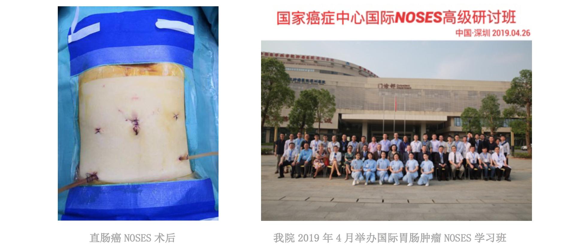 拉屎有血怎么判断是痔疮还是癌,有痔疮大便擦出血是肠癌吗