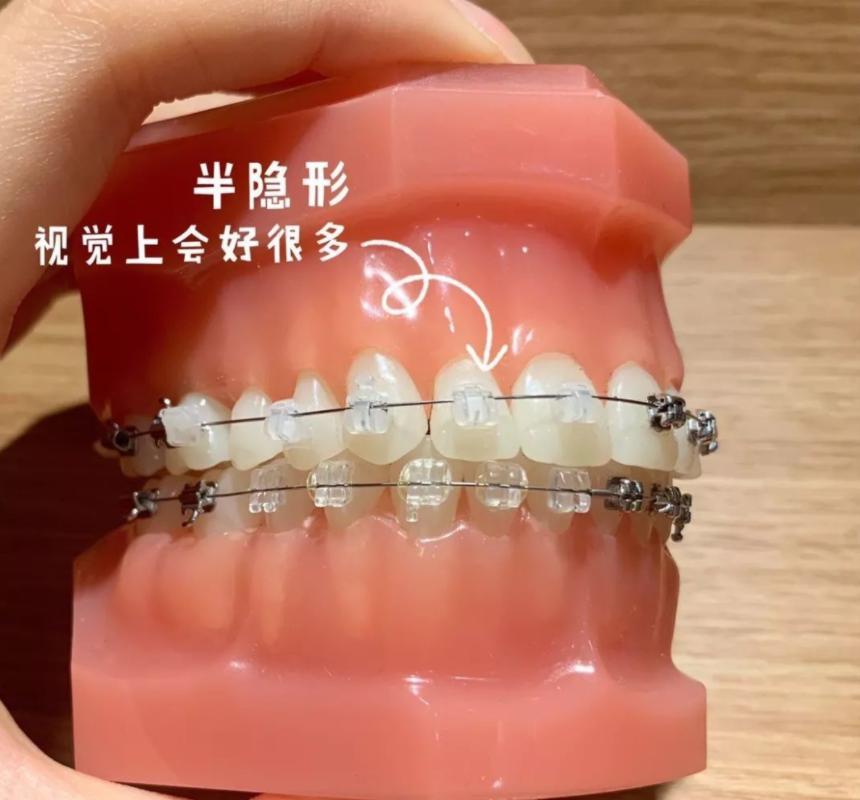 为啥进行牙齿矫正价钱不一样,最好的牙齿矫正需要多少钱