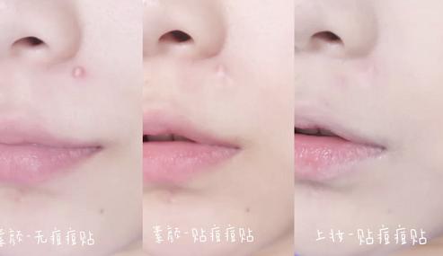 片仔癀痘痘贴解救痘痘,片仔癀祛痘印最有效的方法