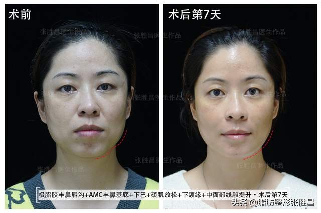 为什么美容医院会给你推荐童颜针,打童颜针危险