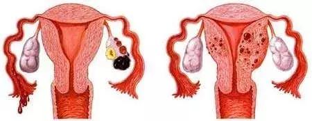 子宫内膜异位症对怀孕的影响,子宫内膜异位怎么会到肺里呢