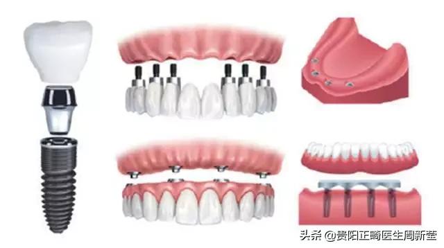 以前装假牙哪里痛了怎么办,老年人戴假牙引起的牙痛怎么用药