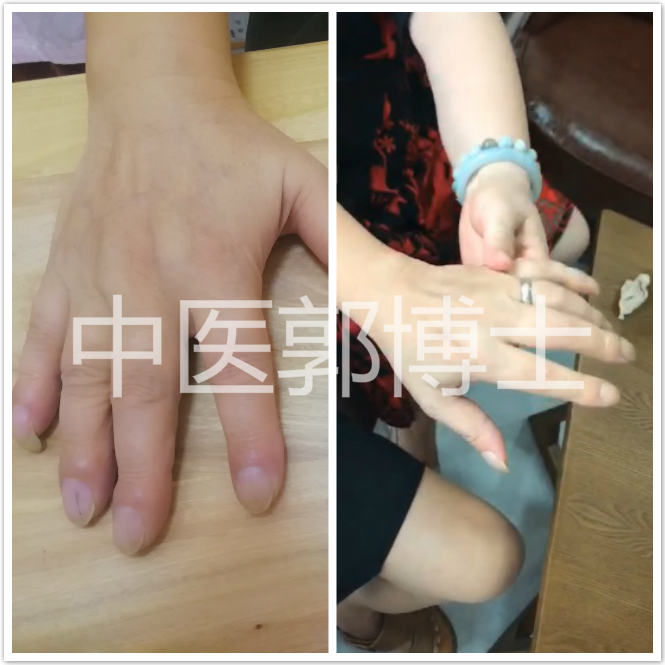 手指肿的已经戴不上戒指了,手指肿胀不能弯曲用什么药