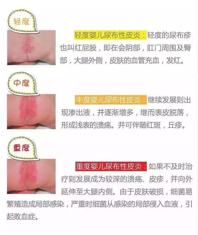 接触性皮炎的西医鉴别诊断,接触性皮炎临床表现有哪些