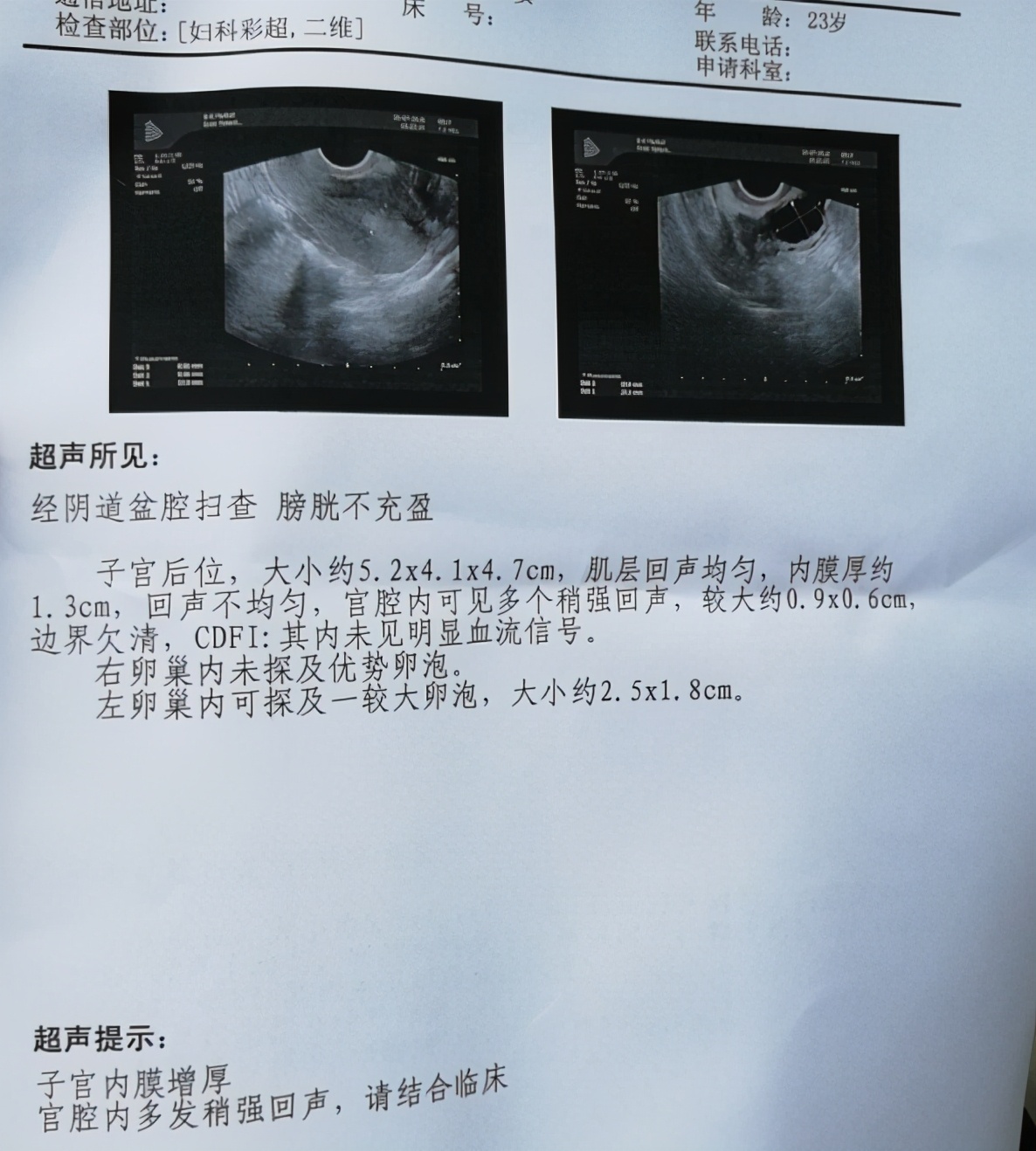 子宫息肉竟是妇科炎症引起的?会导致不孕吗?妇科专家教您咋预防