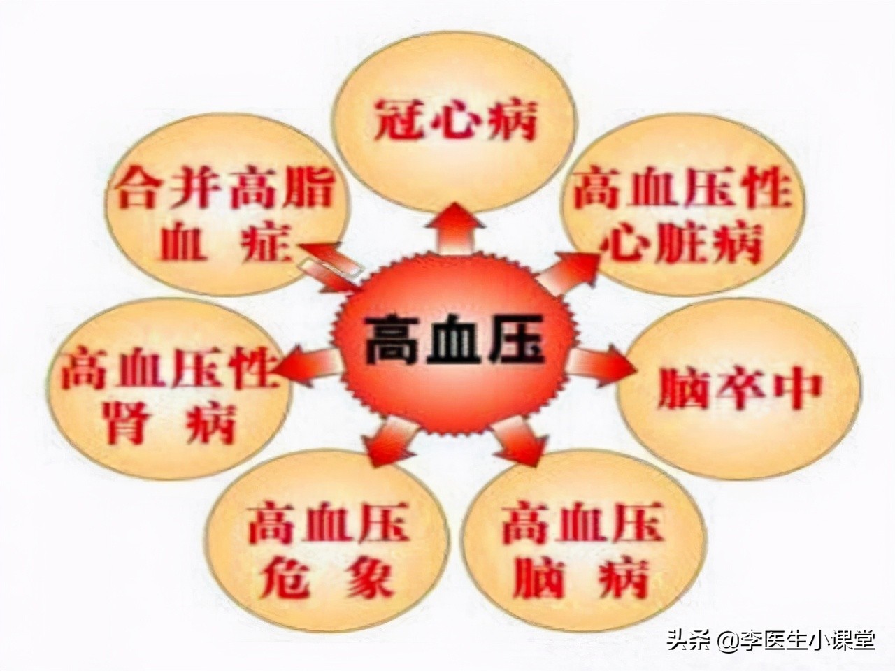 血压132184mmhg是高血压吗,血压为135-100mmhg为几级高血压