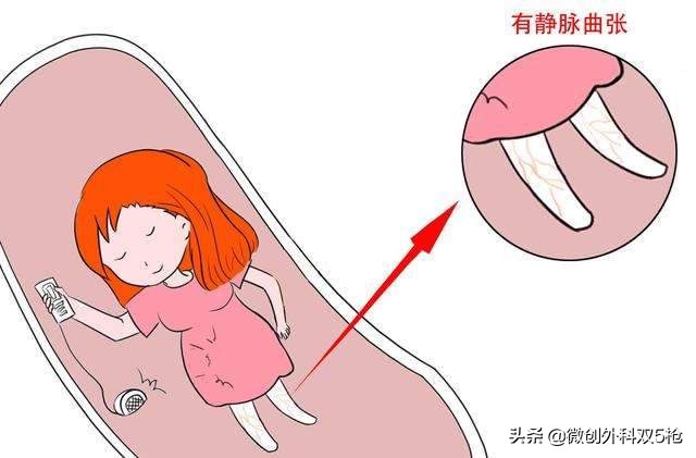 静脉曲张的腿怎么能穿裙子,静脉曲张夏天穿裙子怎样掩饰