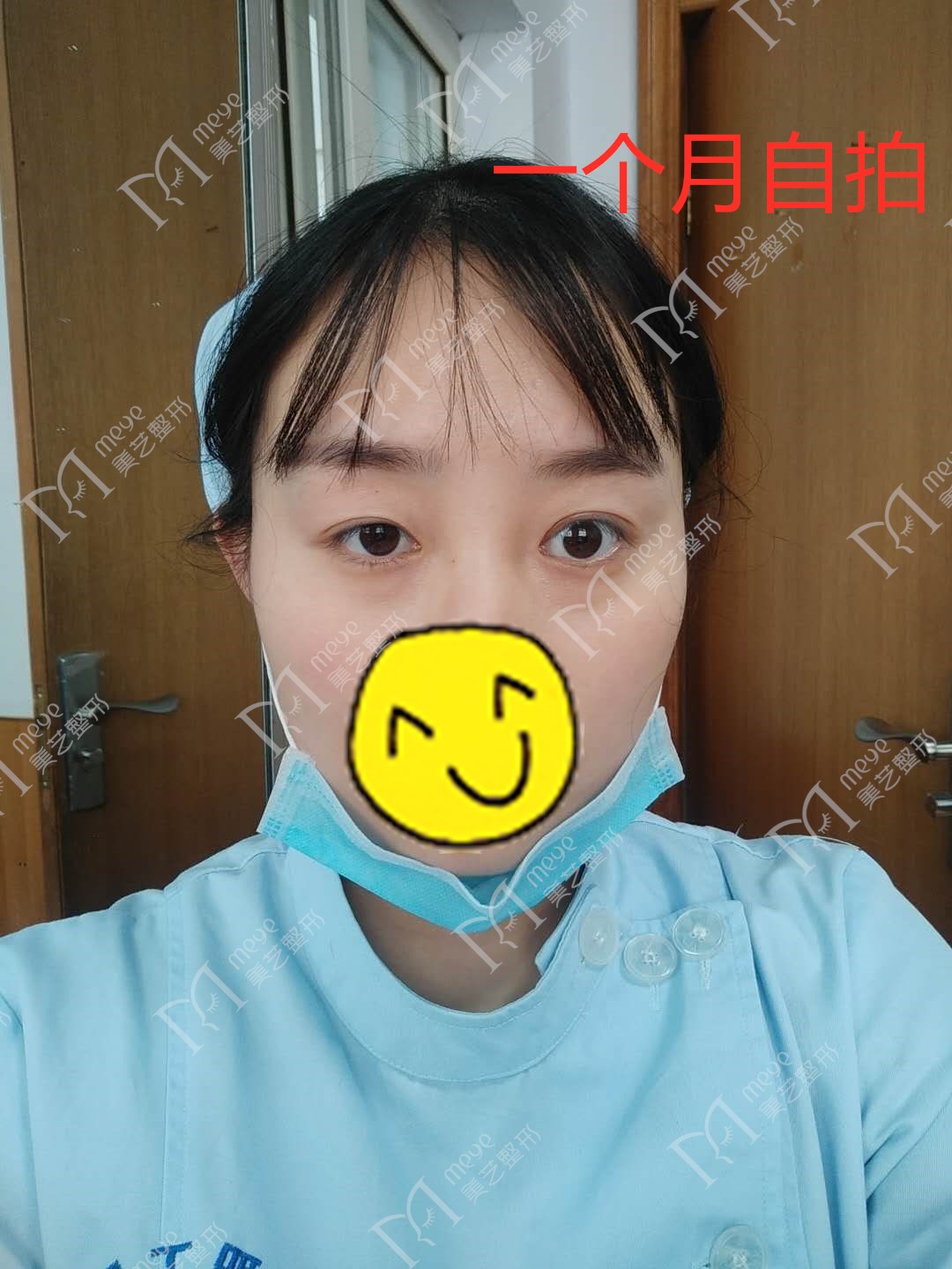 女子双眼皮术后大小眼,大小眼做了双眼皮感觉眼角不对称