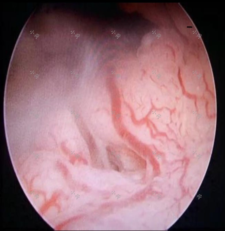 80岁老太太子宫癌,老年子宫内膜癌