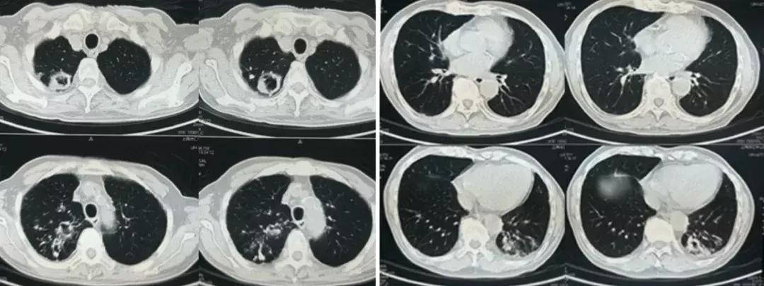 不明原因胸腔积液案例,胸腔积液病例
