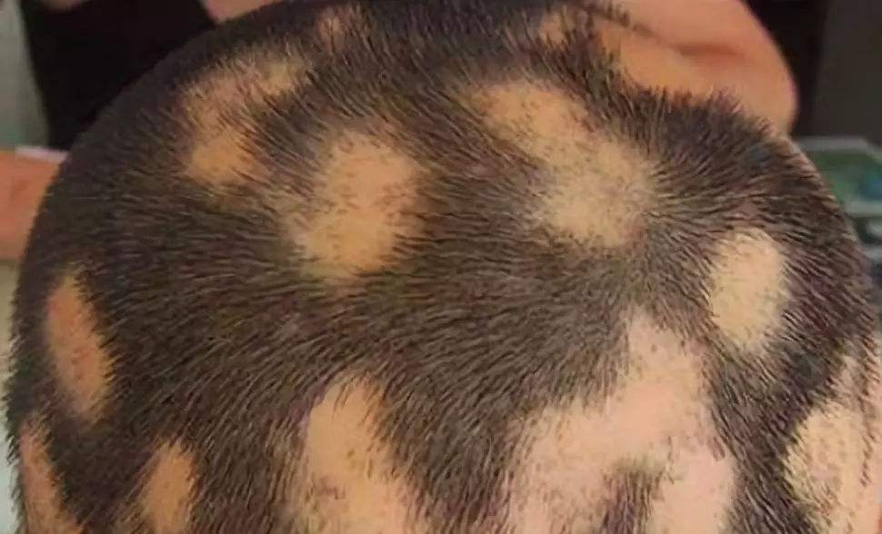 年纪轻轻就秃了怎么办,25岁就秃了怎么办