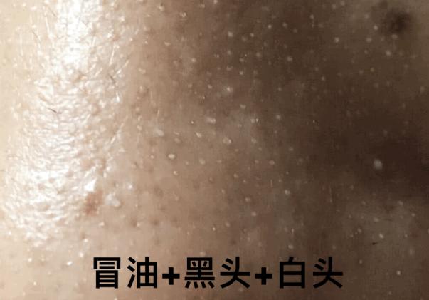 有黑头和没黑头有什么区别,没有长过黑头却长黑头怎么办