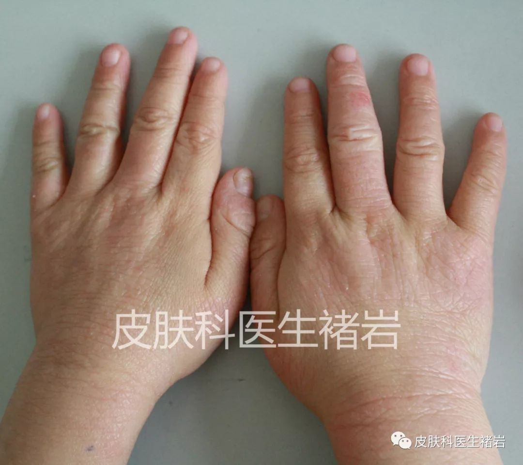 湿疹性皮炎长什么样,脸上湿疹长什么样