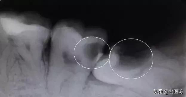 拔智齿：讳疾忌医有什么后果？