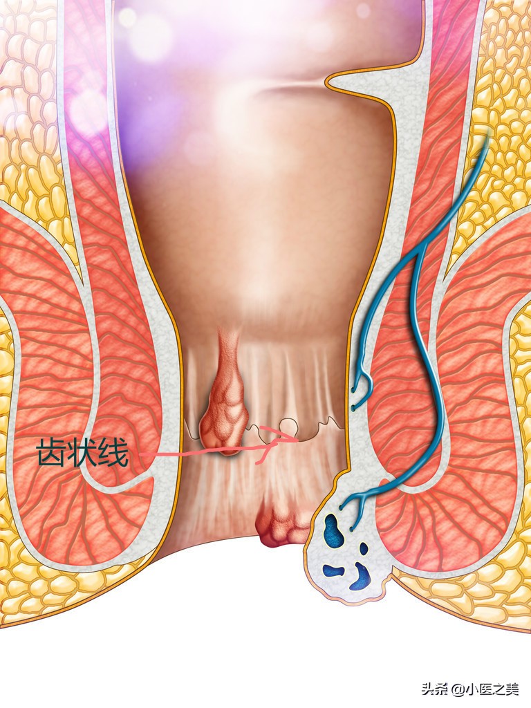 痔疮大便后小便有血怎么回事,大便后痔疮出血怎么办