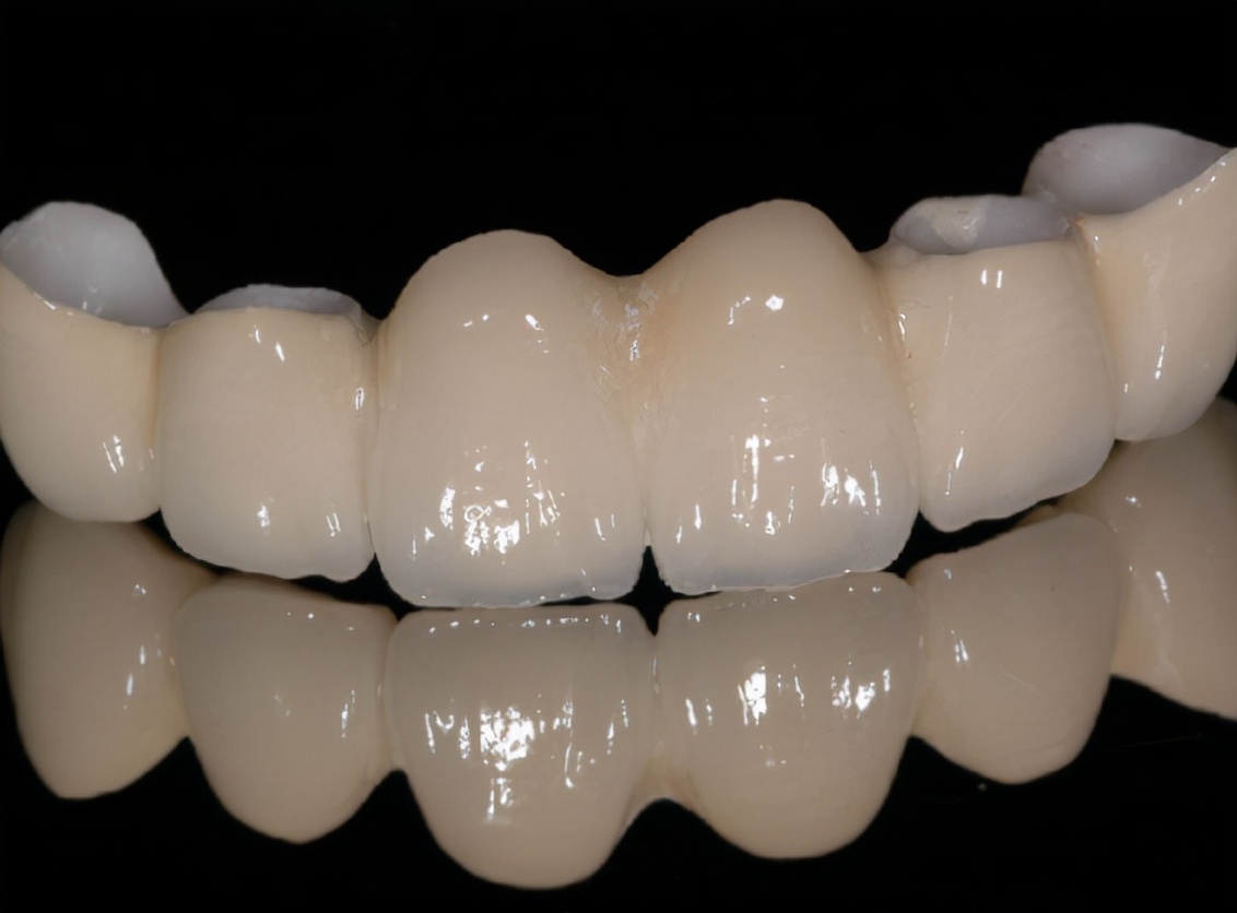 烤瓷牙破冠怎么办,基牙损坏保留烤瓷冠