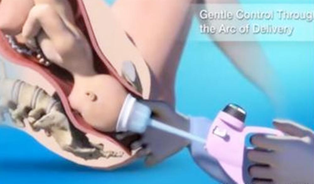 助产士的接生手法有哪些,产房的助产器具