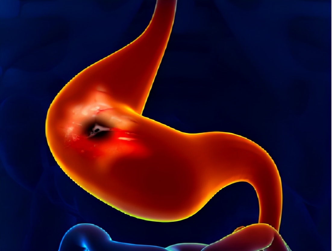 长期服用阿司匹林肠道出血怎么办,阿司匹林吃多怎么办