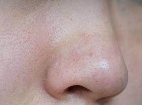 毛孔粗大如何改善真实有效,毛孔粗大收缩毛孔最科学的方法