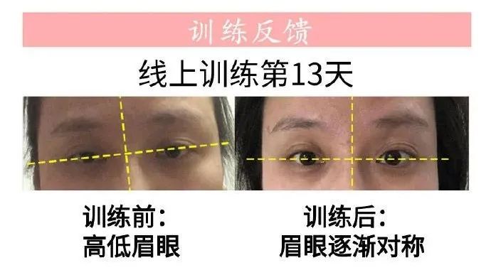 面部不对称程度怎么界定,高低肩会影响面部吗