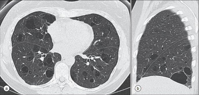干燥综合征是什么样的症状,干燥综合征是什么样的