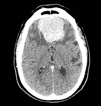 张医生大白话：一文读懂脑膜瘤