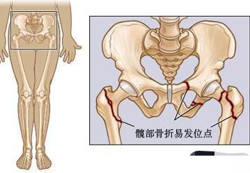老人髋骨置换术后脱位如何处理,90岁老人摔断髋关节怎么办