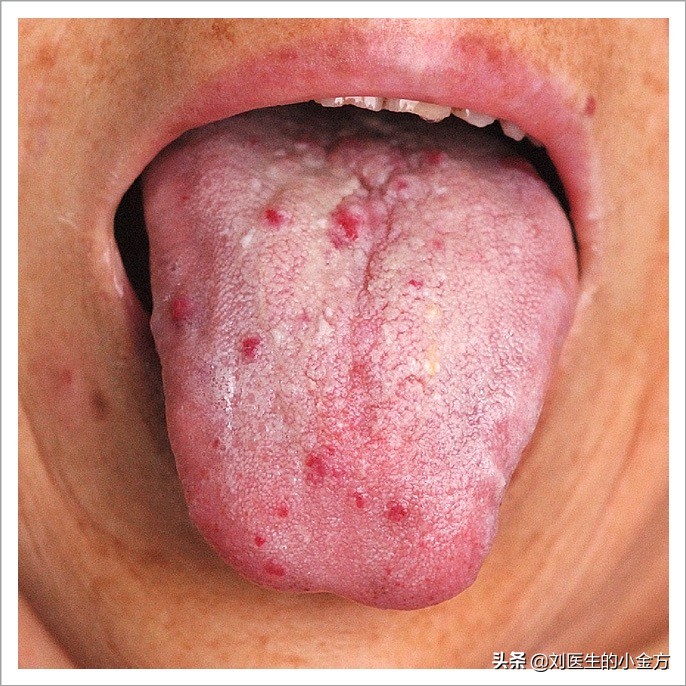 中医舌诊图解100例,中医舌诊图与舌诊口诀