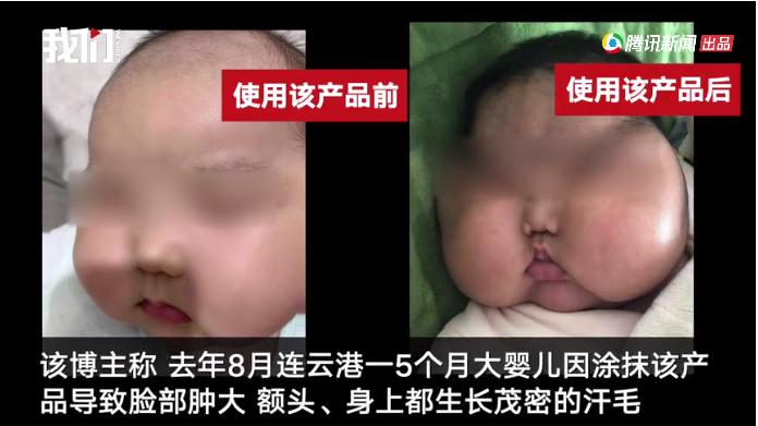 用激素面霜的大头宝宝,激素润肤霜致婴儿成大头娃娃