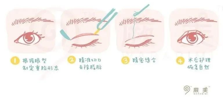 到底该不该全切双眼皮,怎么判断自己该不该割双眼皮