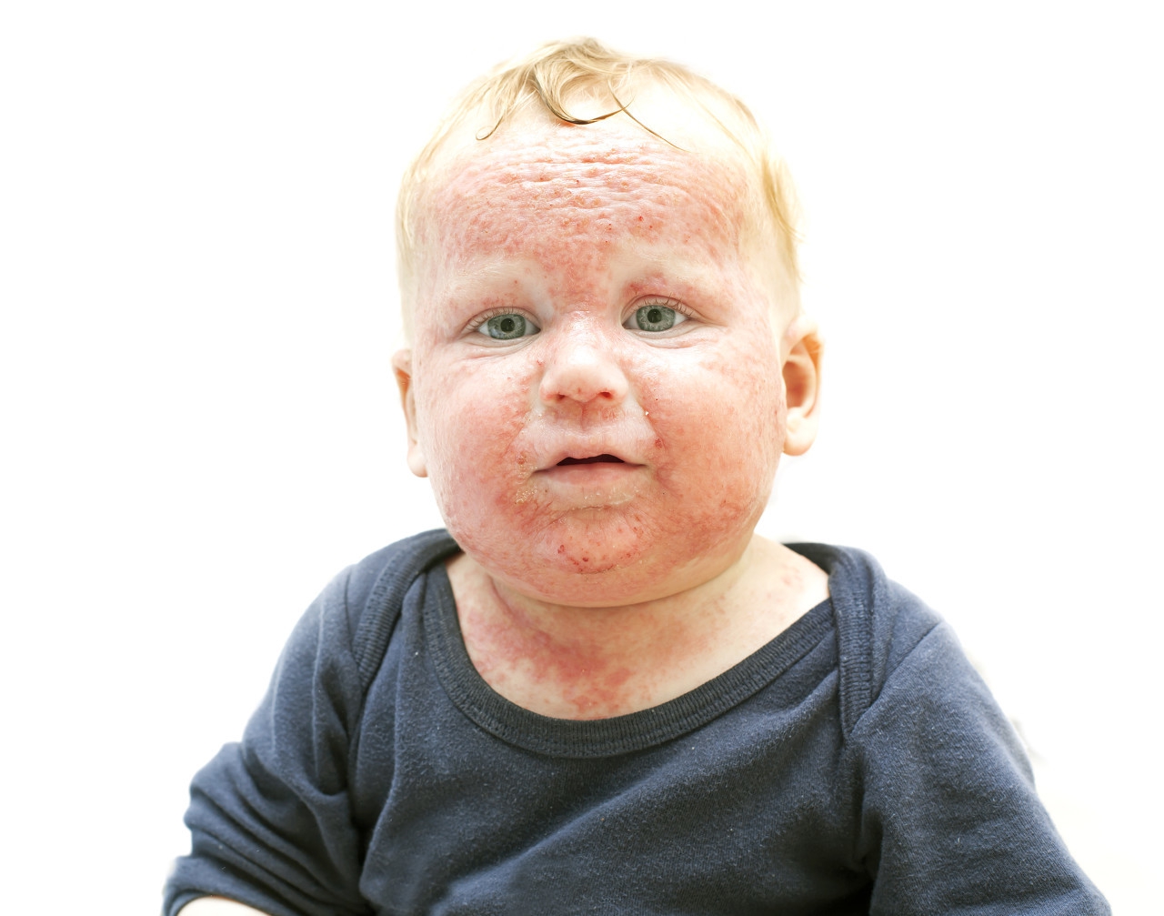 湿疹抹药成大头娃娃,湿疹大头娃娃