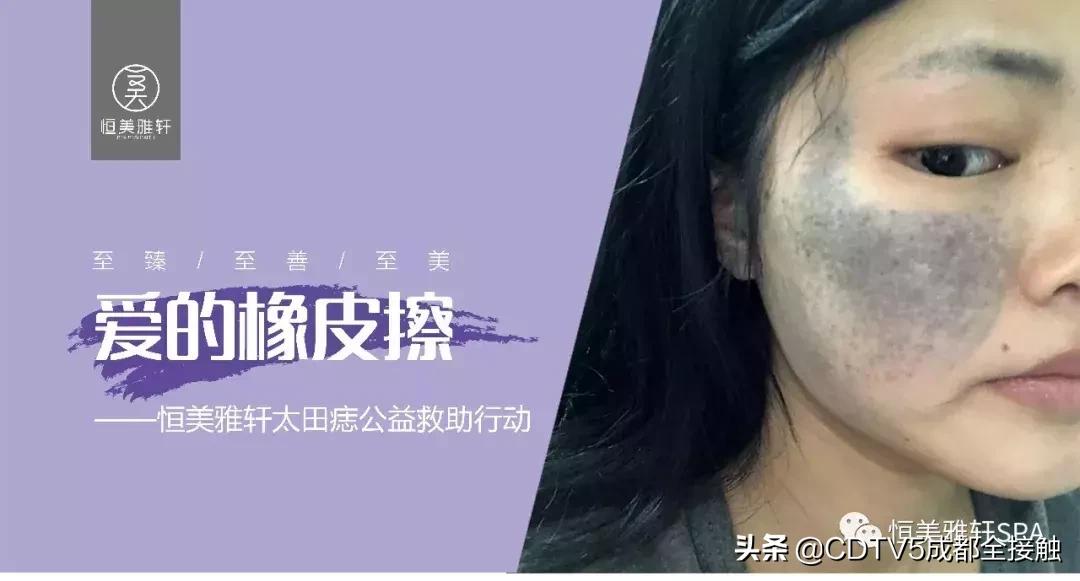 恒美胎记,恒美公益