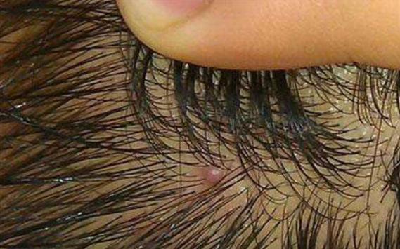 硫磺去头螨头屑止痒洗发水,油头头螨洗发水推荐