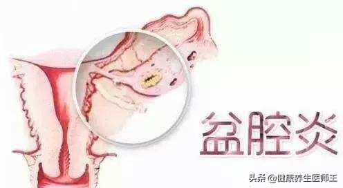 人体健康之盆腔炎(一)