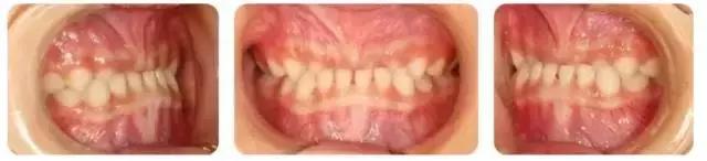 地包天早期矫正最佳时间,地包天10-15岁矫正是最佳年龄吗