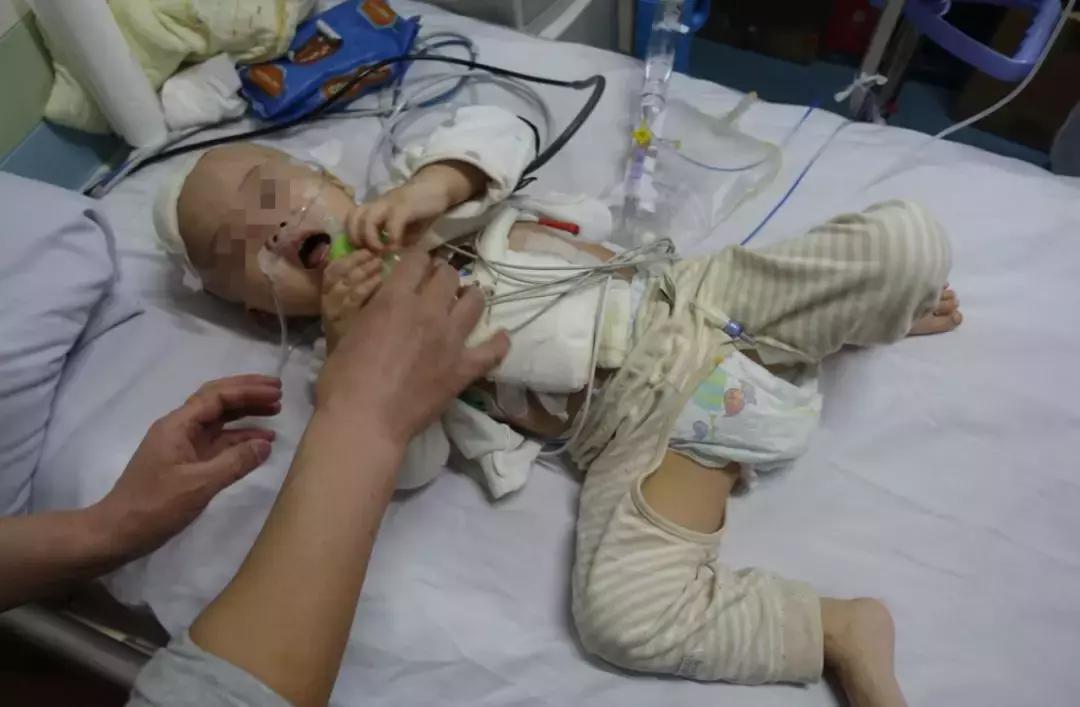 孩子脑积水反复发烧,婴儿脑积水引起发烧如何保守治疗