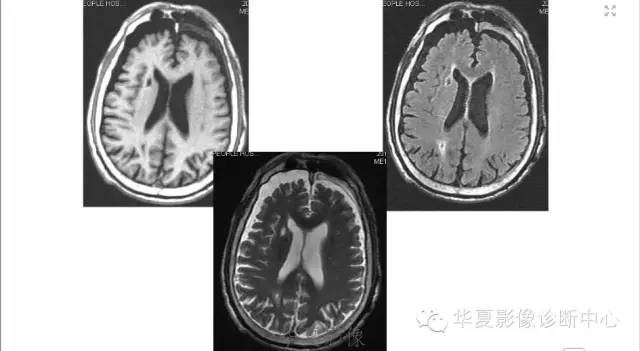 一文读懂颅内胆脂瘤,一文看懂背后的真相