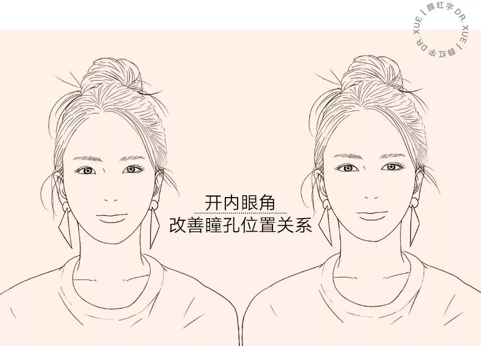 从美术角度谈眯眯眼,开内眼角传统术式