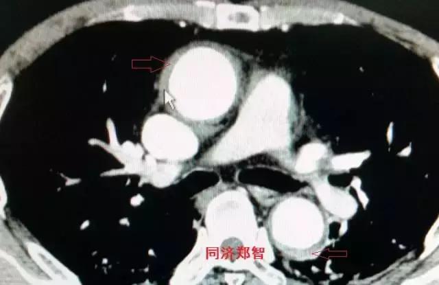 磁共振可以替代cta检查主动脉夹层,主动脉夹层cta上如何分辨真假腔