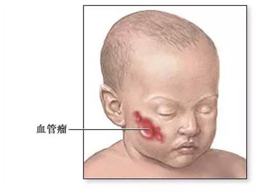 血管瘤会反复发作吗,海绵状血管瘤反复出血怎么办