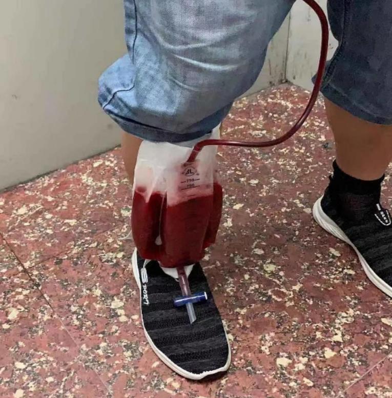 56岁男性发现双肺,56岁男性发现双肺数百个结节