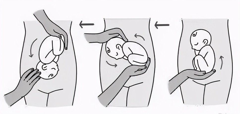 胎位不正乾坤大挪移,乾坤大挪移孕妇