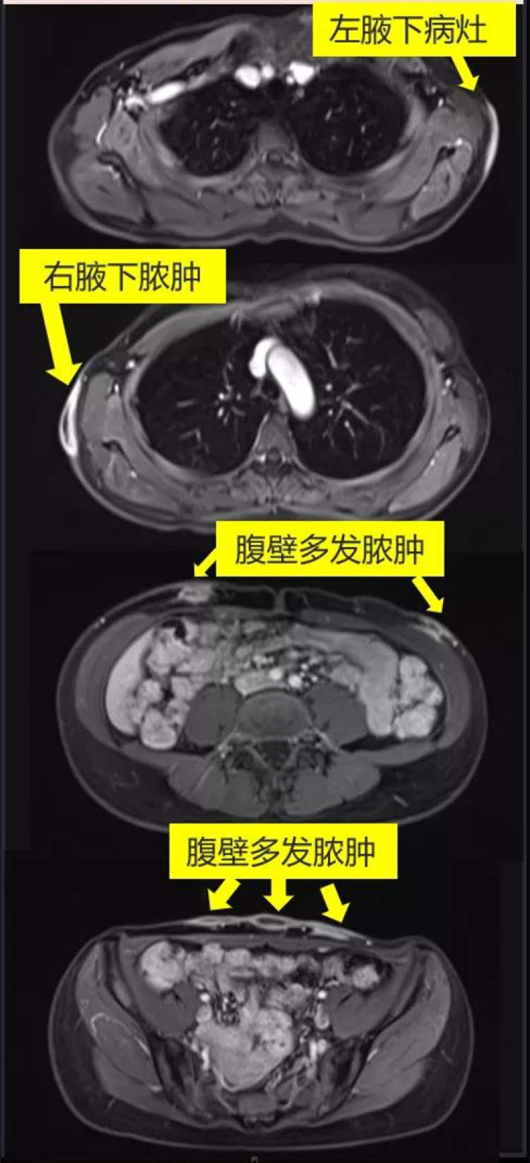 埋线减肥后感染针眼,埋线减肥会导致细菌性感染吗