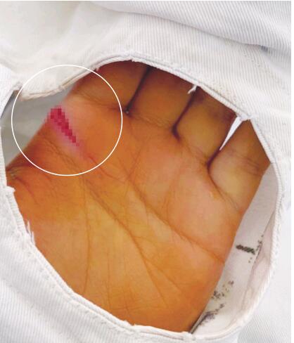 切菜案板小孩,7岁小孩切菜切到手