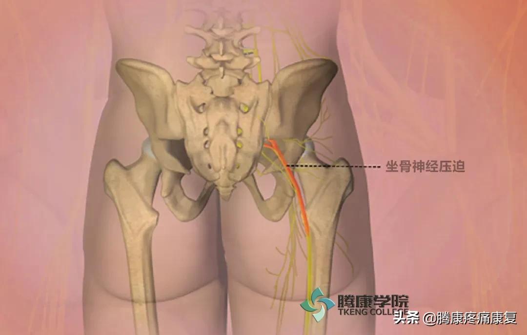 坐骨神经痛是哪个位置图,坐骨神经痛的原因与诊疗