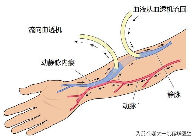 肾移植术后闭瘘手术需要多少钱,肾移植术后内瘘堵还要不要通